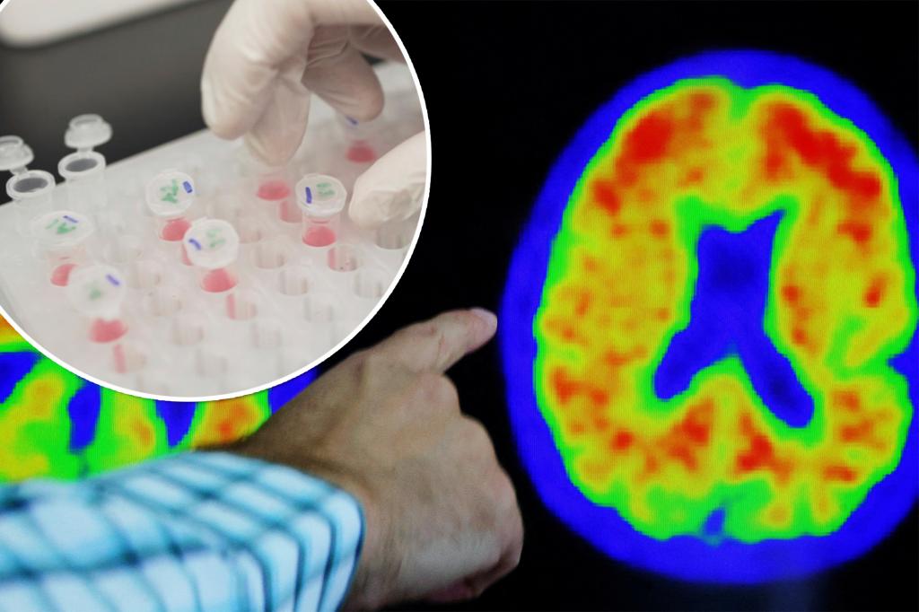 Accuracy of blood tests for Alzheimer's disease varies: study