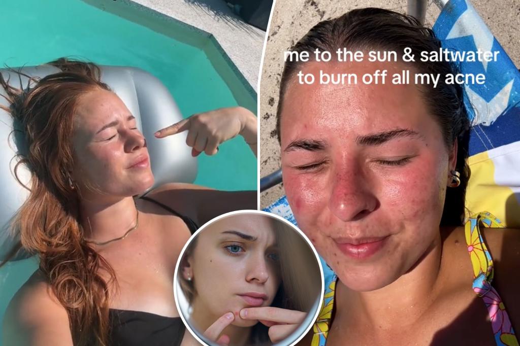 Acne sufferers swear by 'crazy' cure - 'sunburn' trend: 'Sorry Mum, it's the only way'