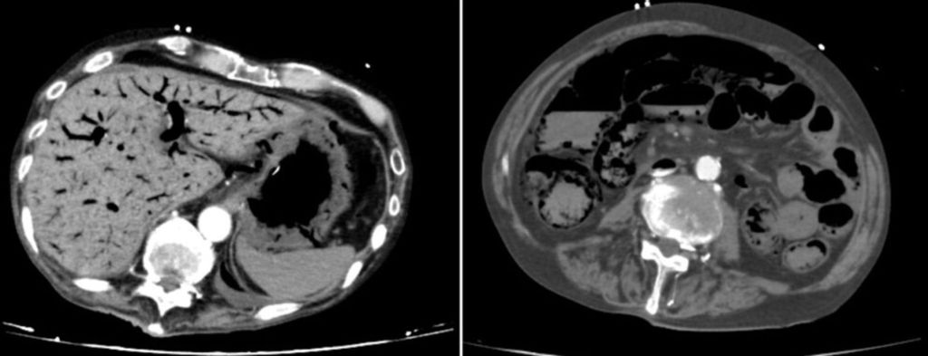 An abdominal scan before he died revealed gas in the intestinal wall.