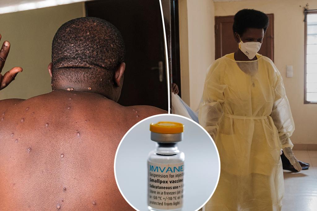 Mpox patient describes terrifying symptoms of new strain amid global outbreak fears: 'So painful I couldn't sleep'